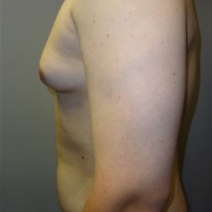 manhattan gynecomastia surgery before 6